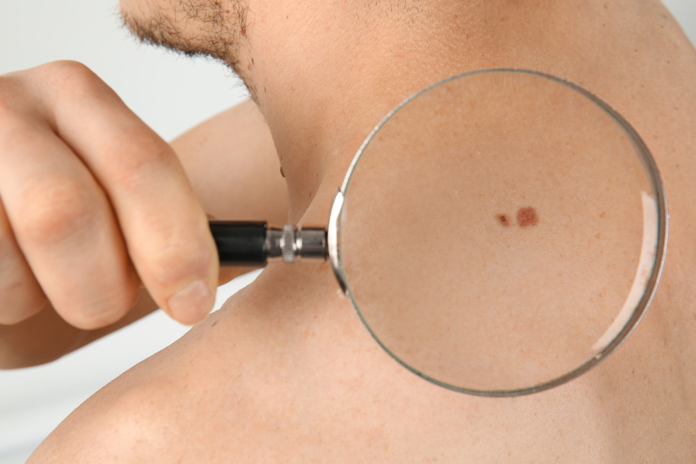 cancer-peau-dermatologue-depistage-france