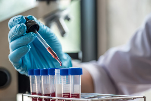 Un test sanguin pour Alzheimer