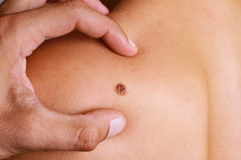 dermatologue-depistage-cancer-peau-semaine-sante