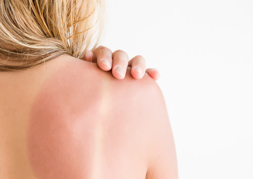 allergie au soleil