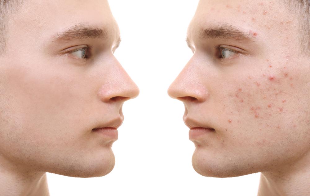 L'acné touche entre 75 à 95% des adolescents et des jeunes adultes.