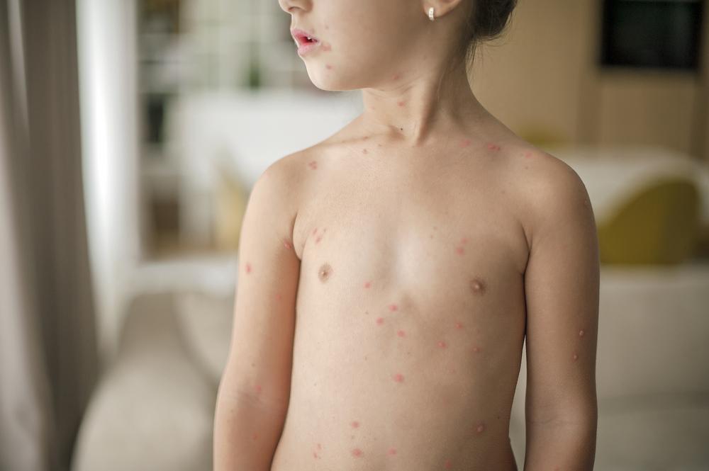 épidémie de varicelle
