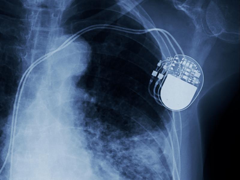 Les pacemakers sont-ils dangereux pour les patients ? 