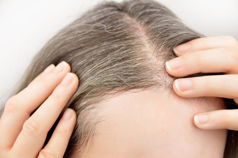 Le système immunitaire jouerait un rôle important dans l'apparition des cheveux blancs