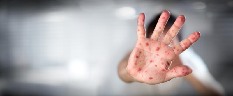 Un homme de 26 ans est décédé de la rougeole selon Santé publique France.