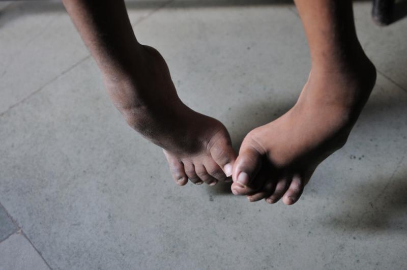 spina bifida Dépakine