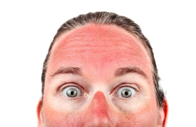 Un sacré coup de soleil...