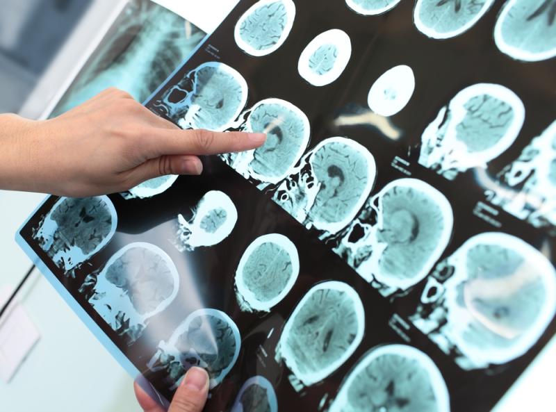 Des cellules souches pour soigner la maladie de Parkinson ? 