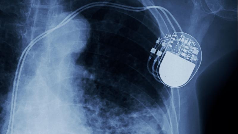 Les pacemakers sont-ils dangereux pour les patients ? 