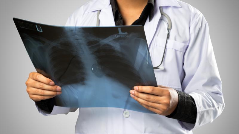 Le cancer du poumon occupe le premier rang en taux de mortalité