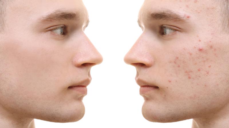 L'acné touche entre 75 à 95% des adolescents et des jeunes adultes.